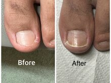 痛かった爪をケアで緩和