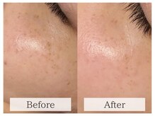 ルミラポー(Lumira Peau)/シミスポット＋肌質改善