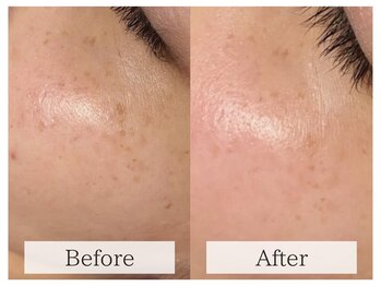 ルミラポー(Lumira Peau)/シミスポット+肌質改善