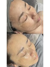 レクシア(LEXIA)/肌質改善症例｜透明感