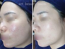 アート ビューティールーム(art beauty room)/☆OPL 光フェイシャル＆ハーブ