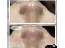 レア(le'a)/大人気毛穴洗浄◎1回の効果