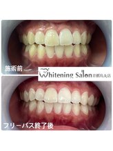 ホワイトニングサロン 京都烏丸店/ホワイトニング施術例