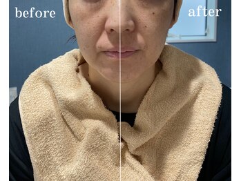 アロラヴィ(AroRavi)/即効！引き締め！根本たるみ改善