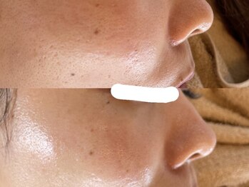 リノアンド(Lino&)/肌質改善