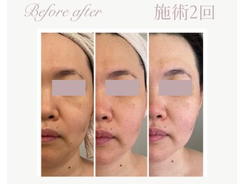 パルタージュ(Partage)/マーメイドセルトリートメント