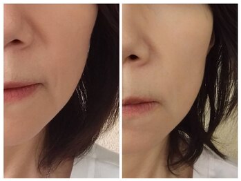 ル リアン(soins de visage Le lien)/SO顔の変化