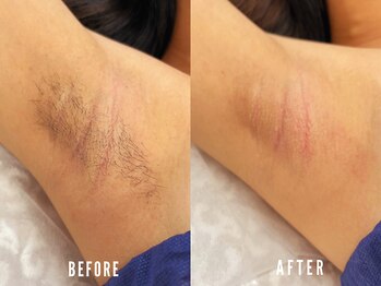 ビーグラム(B.GLAM)/ダブル脱毛／脇