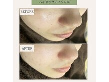 ベル 下北沢(Belle)/ハイドラフェイシャル