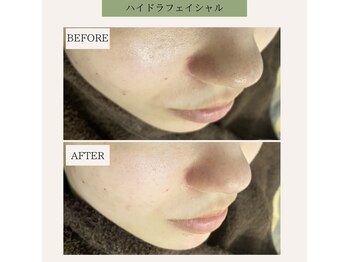 ベル 下北沢(Belle)/ハイドラフェイシャル