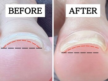 ヘブンリープラス＋ Luz湘南辻堂店の写真/巻き爪ケアで足元をもっと快適に…。お一人ひとりの爪の状態に寄り添い、丁寧にケアいたします。