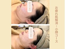 エイミー(Aimee)/【小顔コース】ビフォーアフター