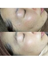 ホワラ 横浜店(Whila)/施術効果１0