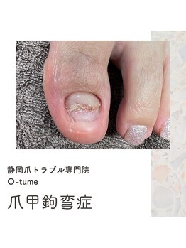 オツメ 静岡(O-tume)/爪甲鉤弯(爪が伸びてこない方)