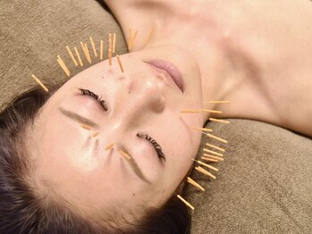 ドリームスタイル 川崎駅前(Dream Style)の写真/大人気！ヒト幹細胞×美顔鍼/美容鍼灸も◎ハーブピーリングorインジェクションで美肌/ニキビケア/肌質改善!