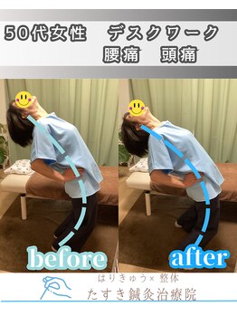 たすき鍼灸院 浦和/30代女性デスクワーク腰痛頭痛