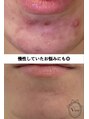 ハーブピーリング 名古屋 慢性悩み 肌質改善