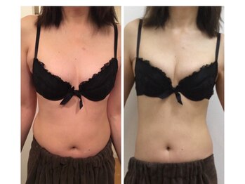 フラフィ 宇都宮本店(fluffy)/お客様症例☆離れ乳