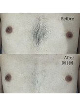 シャレールオム(Chareir Homme)/胸脱毛１回ビフォーアフター