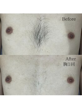シャレールオム(Chareir Homme)/胸脱毛１回ビフォーアフター