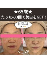 カブール 町田/65歳★たったの3回で美白肌に！