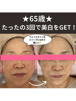 カブール 町田/65歳★たったの3回で美白肌に!