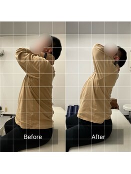 ナオル整体 池袋院(NAORU整体)/猫背矯正の施術前後