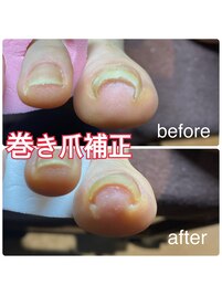 巻き爪補修