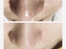 ランソ ビューティー 成田(RUNSO Beauty)/ハイドラフェイシャルで美肌