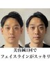 【2回目以降美容おすすめ施術】小顔矯正＋美容鍼　¥22,000→¥15,000