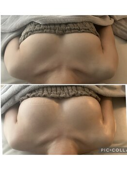 キレイバスト(Kireiii Bust)/ビフォーアフター