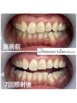 ホワイトニングサロン 京都烏丸店/ホワイトニング施術例