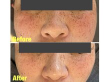 シェノン(Chainon)/フェイシャル光フォト