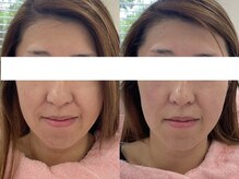 シミケア専門店 SAKURA 平塚店/平塚/シミ/しみ/たるみ