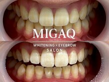 ミガク 京都四条大宮店(MIGAQ)/京都/四条大宮/ホワイトニング