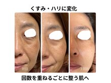 ハナナ(Hanana)の雰囲気（天満/毛穴ケア/30代/40代/ハリ透明感/小顔/顔脱毛/大阪天六）
