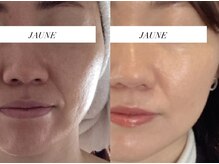 ジョーヌ(JAUNE)の雰囲気（気になるほうれい線を撃退し、若々しい印象へ激変◎）