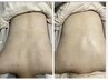 【繰り返す背中ニキビに】背中ブツブツ国産ハーブピーリング(脱毛なし)