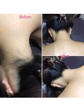 アンジュヴィバラヴィーダ(Ange viva la vida)/脱毛