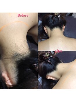 アンジュヴィバラヴィーダ(Ange viva la vida)/脱毛