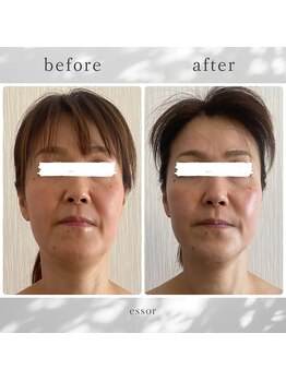 エソール(essor)/不安定な肌状態を改善♪
