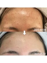 エステティックジュビラン アンビエンテ 福井南店/角質ケア＆美白、保湿ケア