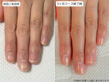 カピリナ(Ka Pilina)/自爪育成・深爪・川崎