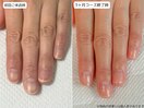 自爪育成・深爪・川崎