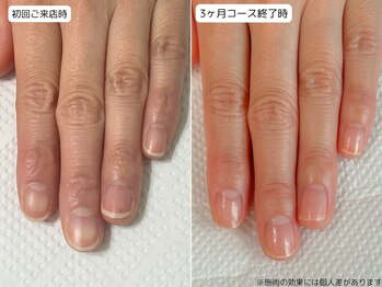 カピリナ(Ka Pilina)/自爪育成・深爪・川崎