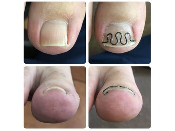 事例【ツメフラ法巻き爪矯正】