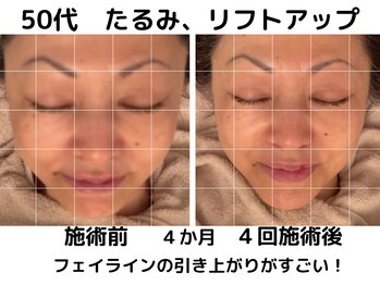 エンジェルエッグ/◆たるみケアならぜひ当店へ！