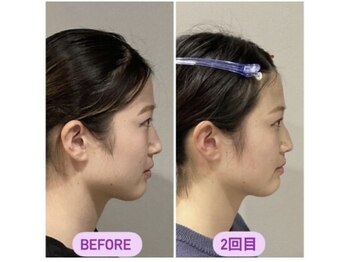 小顔22 ボルティ 本店(Bolty)/初回・2回目