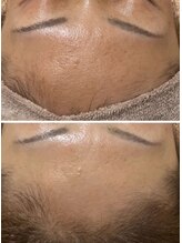 ファルファラ(farfara)/天然ハーブピーリング