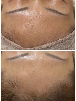 ファルファラ(farfara)/天然ハーブピーリング